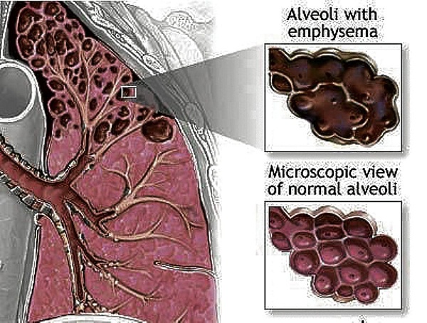 Copd Airways