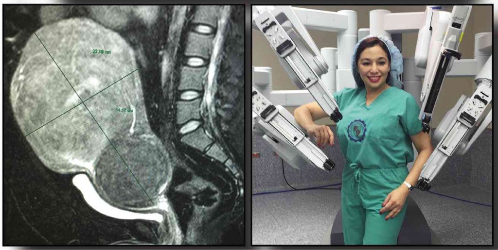 FOR the first time in the country, Singson succeeded in removing a 2.7-kilo solid uterine mass using robot made up of four interactive robotic arms equipped with high-performance vision system and patented EndoWrist instruments.